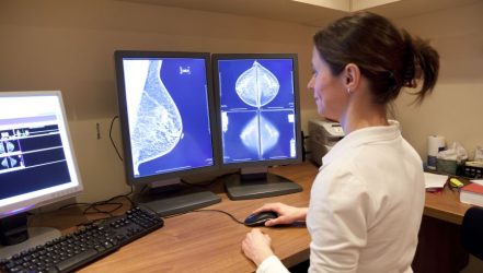 The Impact Of Artificial Intelligence In Transforming Breast Cancer Detection